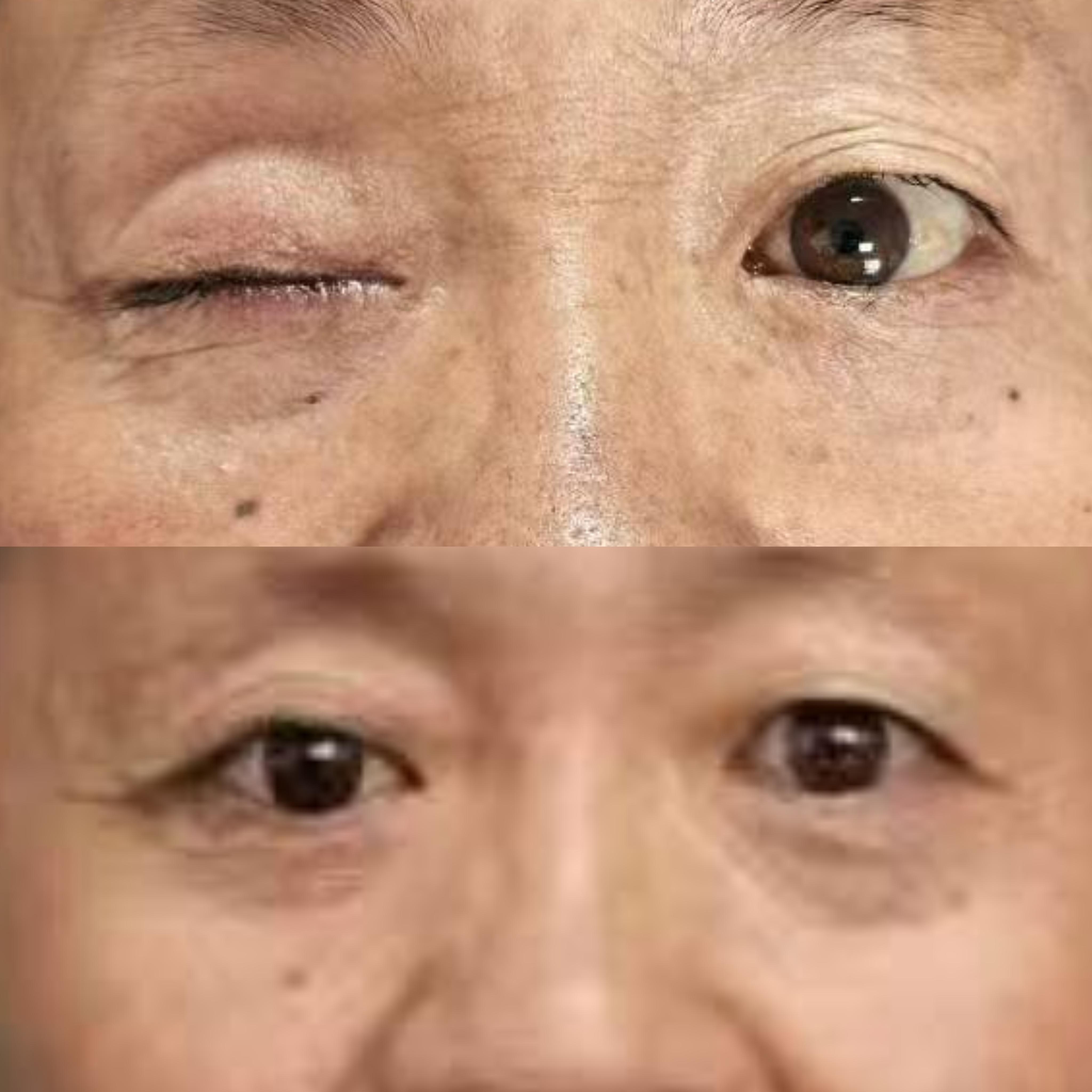 揭秘眼睛失明后眼球萎缩的时间之谜
