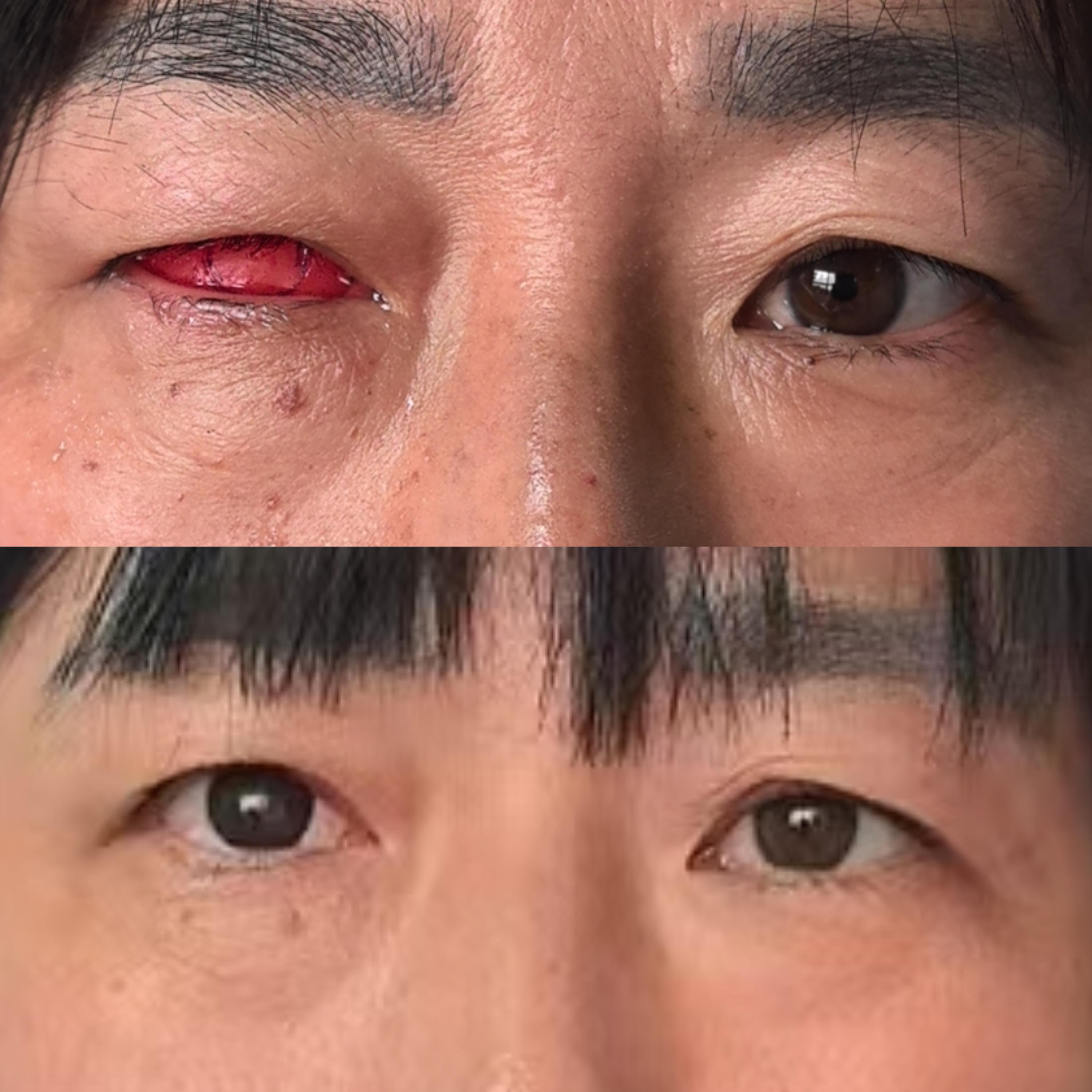 定制义眼到底需不需要本人到现场呢