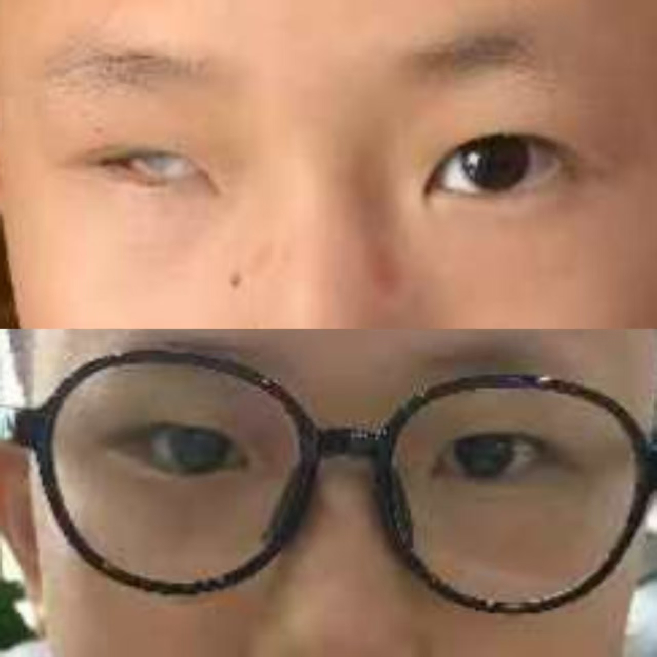 为何选择安装义眼提升生活品质与外观