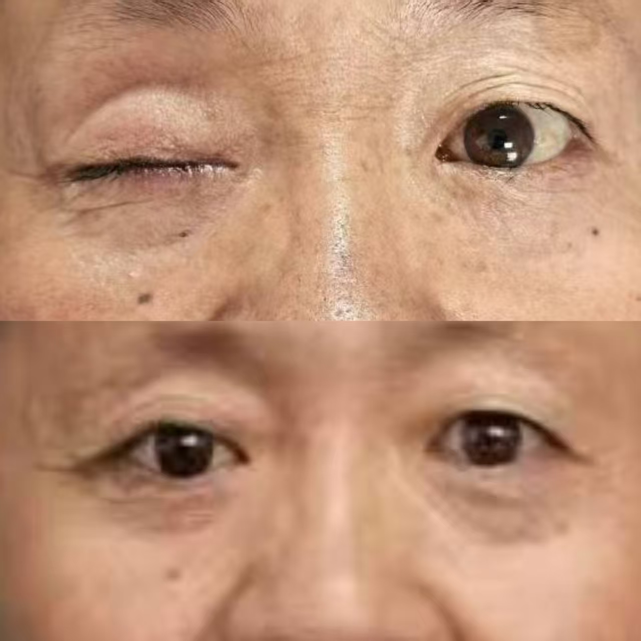 一只义眼价格及费用详解