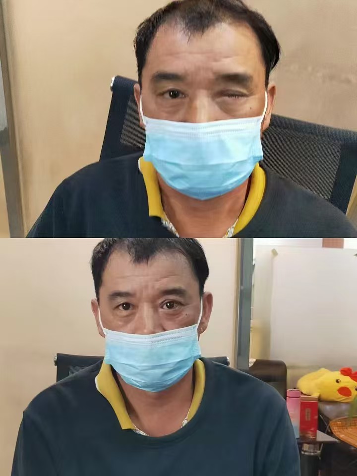 廉价义眼为视障者带来新希望