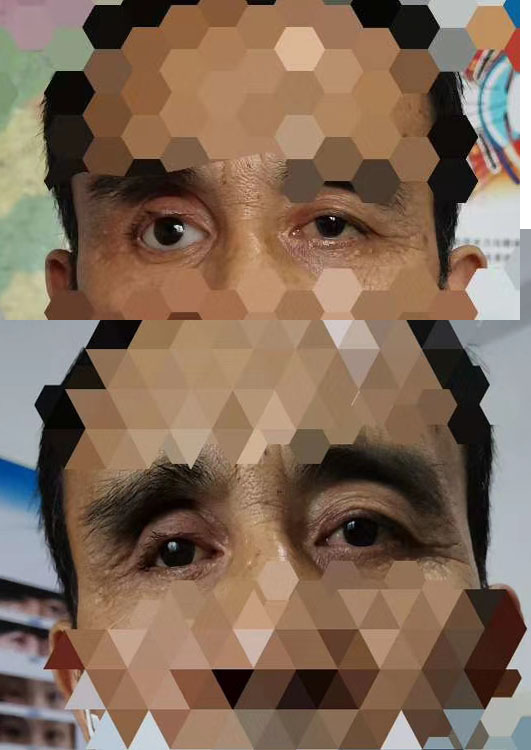 义眼台使用寿命及影响因素解析