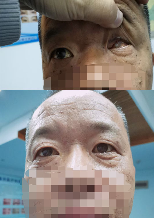 全面了解义眼定义及功能