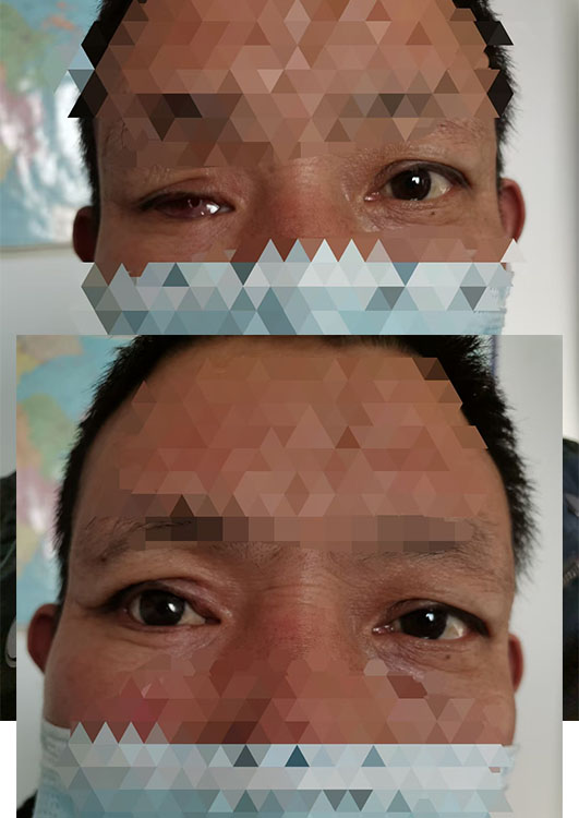 杭州专业假眼定做服务中心简介