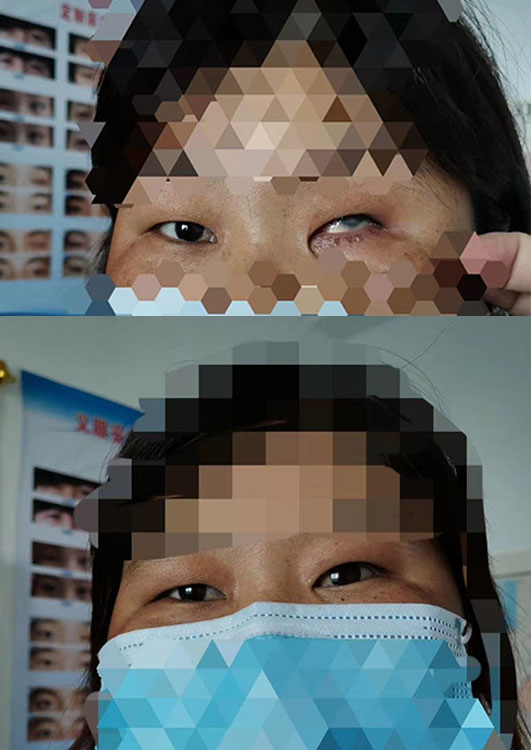 杭州人工假眼技术革新让生活更美好