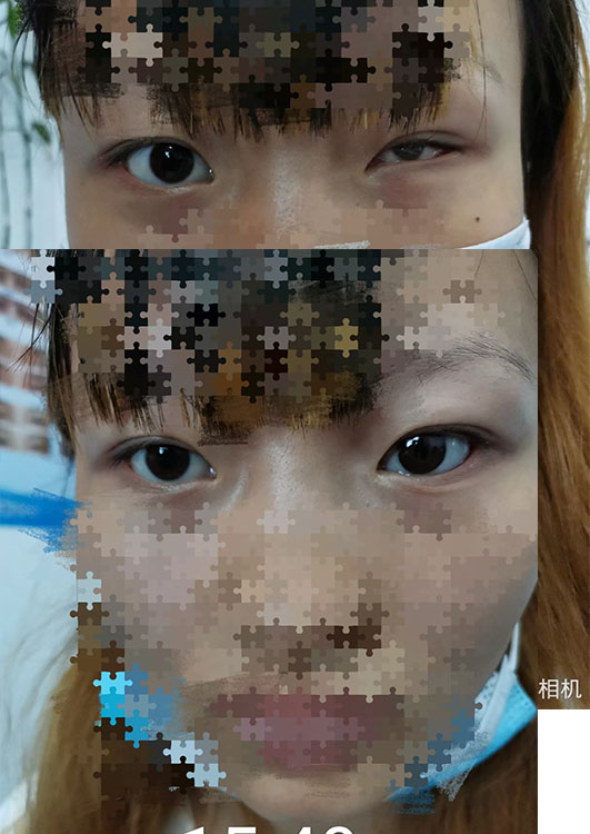 浙江领先技术打造逼真先进义眼