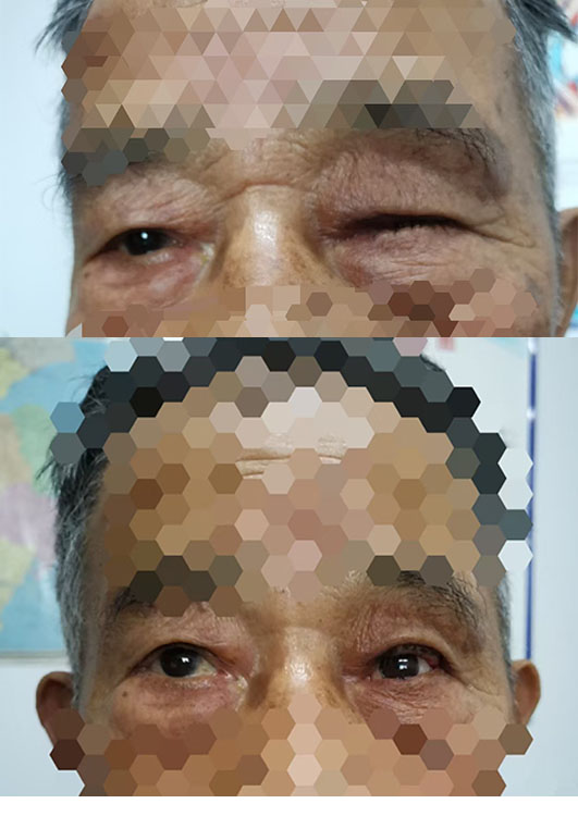 高分子义眼为单眼人士提供了哪些便利