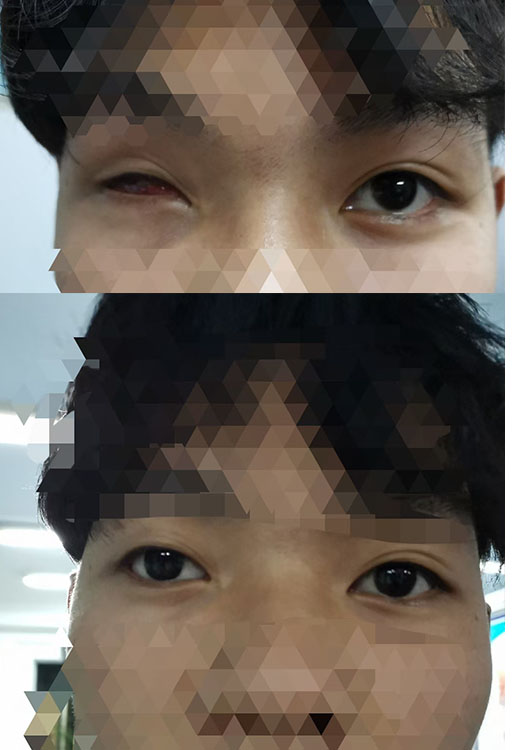 选择义眼的注意事项！！