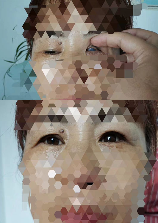 义眼究竟是什么